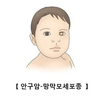 아이들 사진 찍을 때 이 증상 있으면 병원가야 한다고 함_2.webp