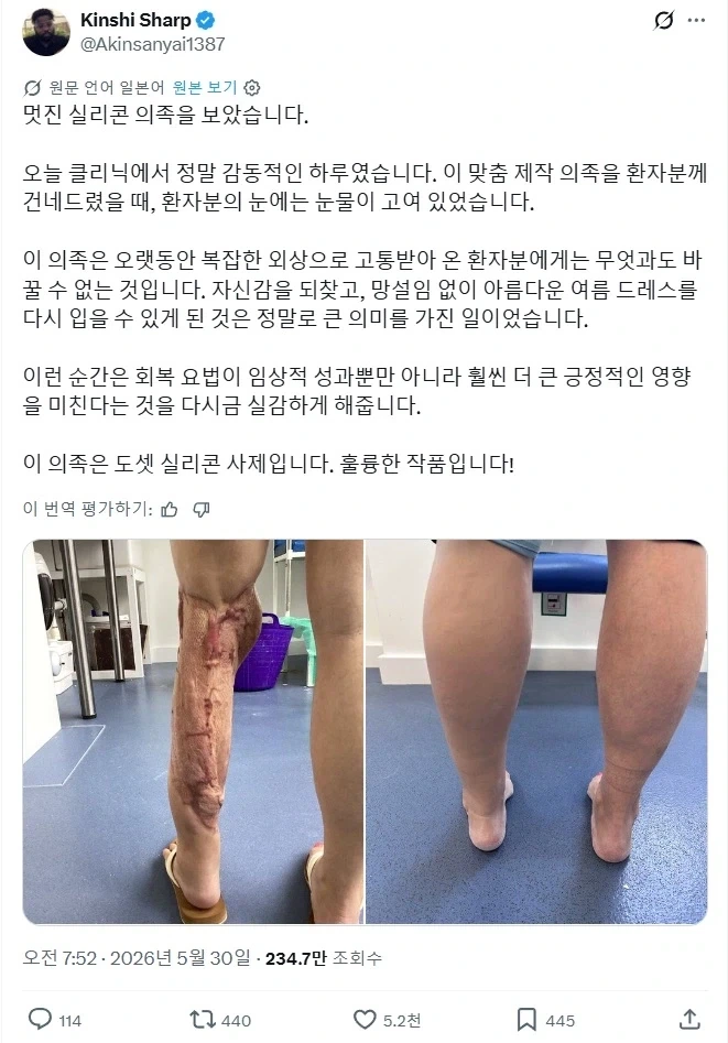 다리의 외상을 숨겨주는 실리콘 의족_1.webp