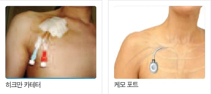 부작용 꽤나 크지만 그래도 사용하는 주사법_2.webp