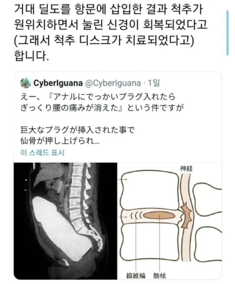 척추디스크 치료방법_1.webp