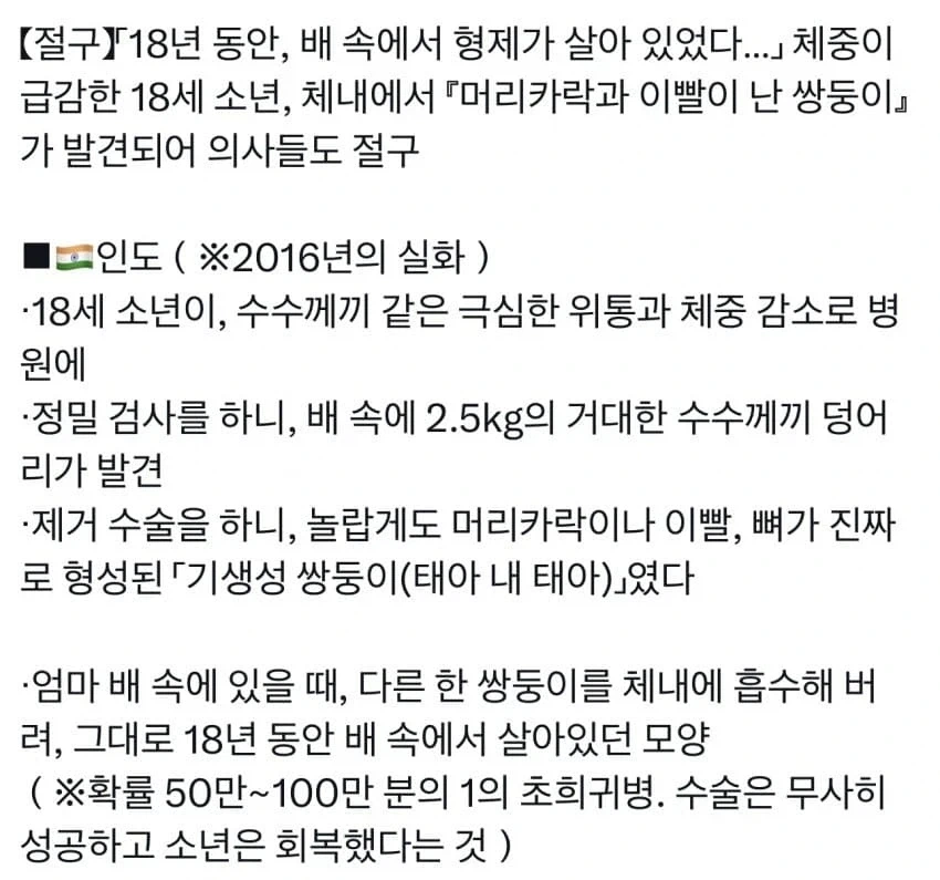 뱃속에서 살아있던 쌍둥이_1.webp