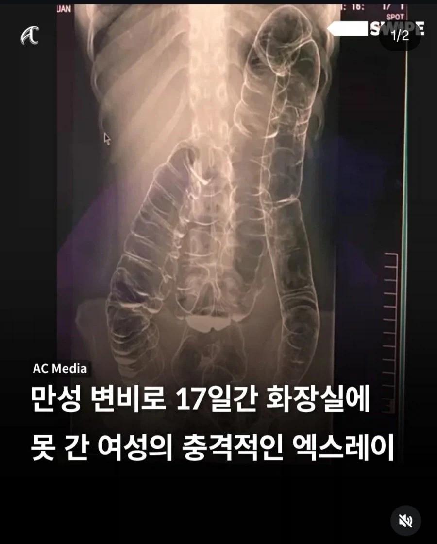 만성 변비로 17일간 화장실 못 간 여성의 몸 엑스레이샷_1.webp