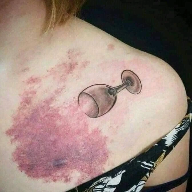 흉터를