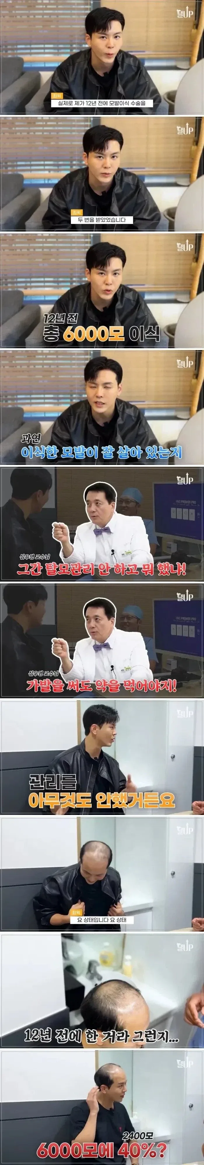 모발 이식후 12년동안 탈모약 안먹었을 때_1.webp