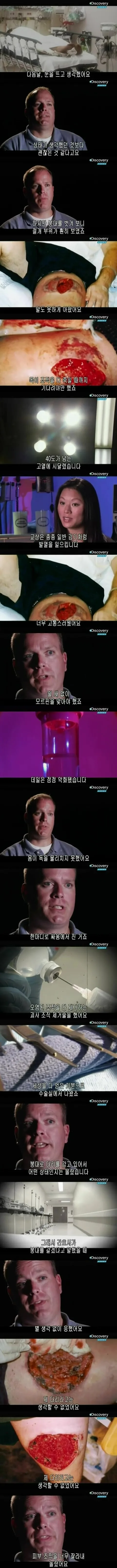 [극혐] 독거미한테 물려서 피부가 괴사한 사례.jpg_5.jpg