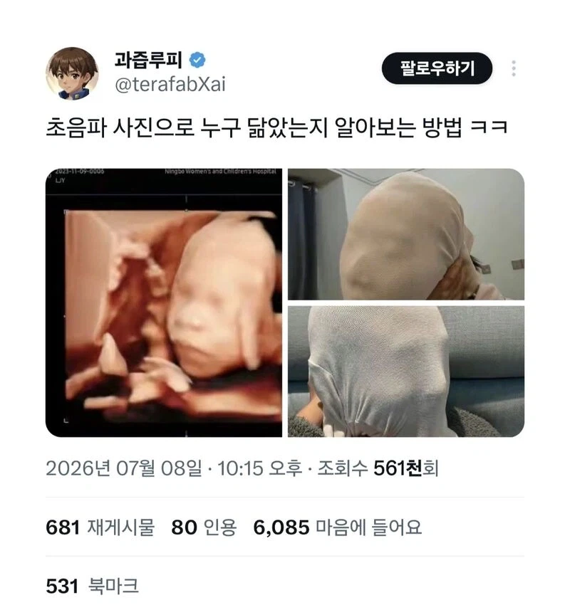 초음파 사진 누구 닮았는지 알아보는 방법_1.webp