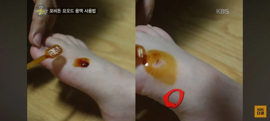 올바른 포비돈 요오드 용액 사용법_1.webp