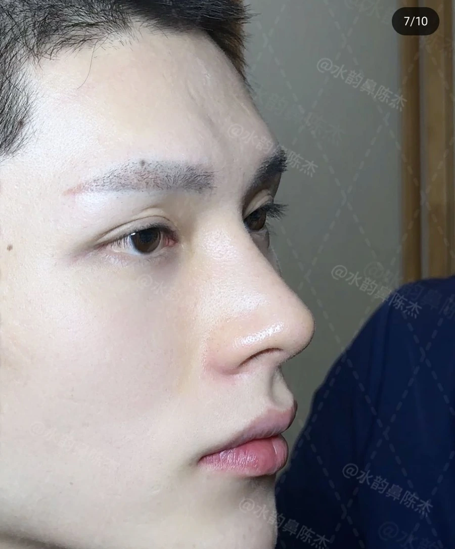 image.png SNS에서 뽑은 남자 코 성형 레전드 비포에프터.jpg