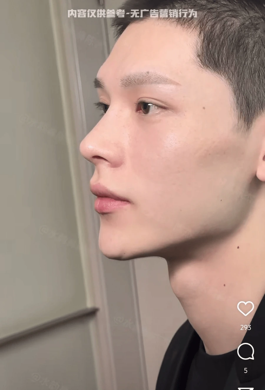 image.png SNS에서 뽑은 남자 코 성형 레전드 비포에프터.jpg