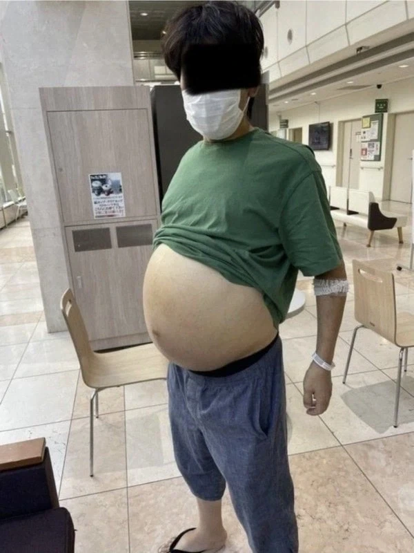 맥주를 10년간 매일 3L씩 마신 일본 남자_1.webp