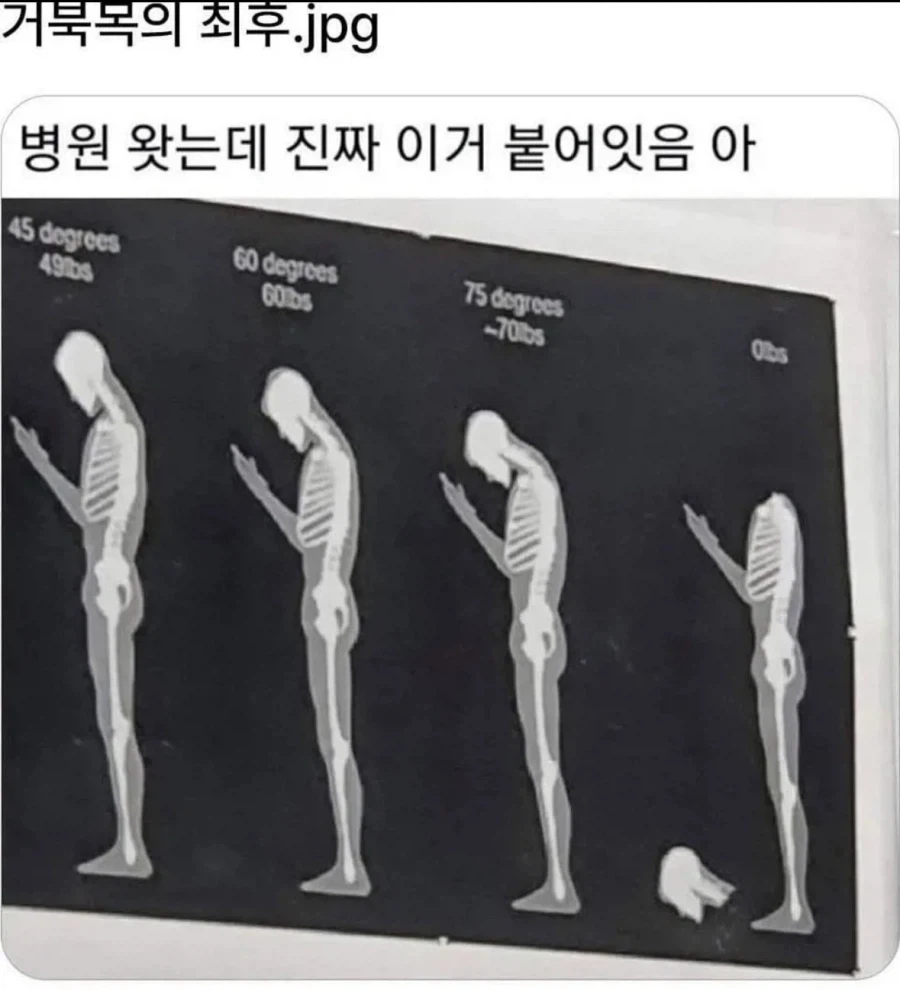 거북목의 최후_1.webp
