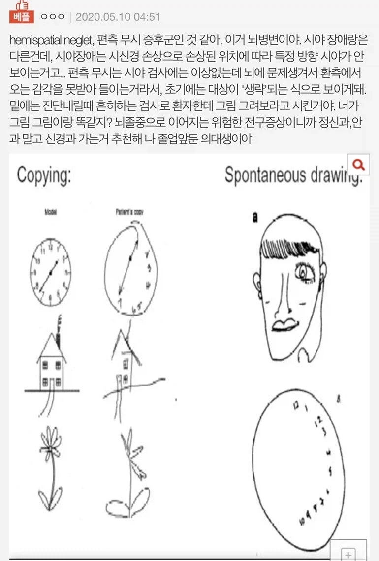 뇌에서 시야 인지를 못하게 한다는 증후군.jpg_2.webp