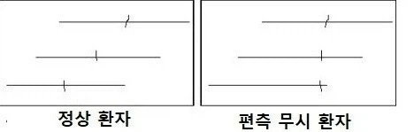 뇌에서 시야 인지를 못하게 한다는 증후군.jpg_3.webp
