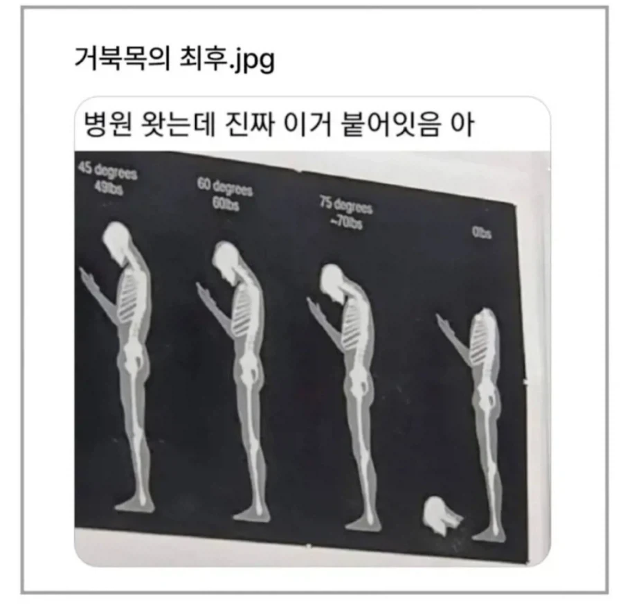 거북목의 최후.jpg_1.webp