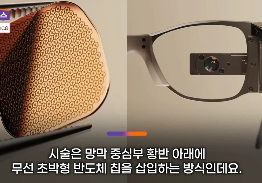 눈에 칩 넣어서 시력 회복해주는 기술_1.webp