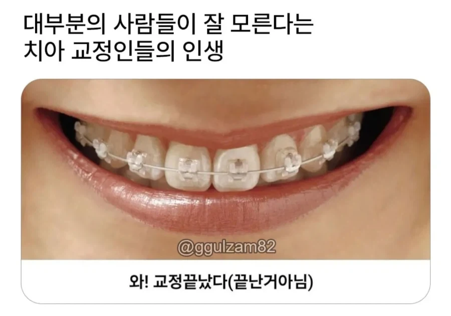 교정 안한 사람들은 모른다는 치아 교정인의 인생.jpg_1.webp