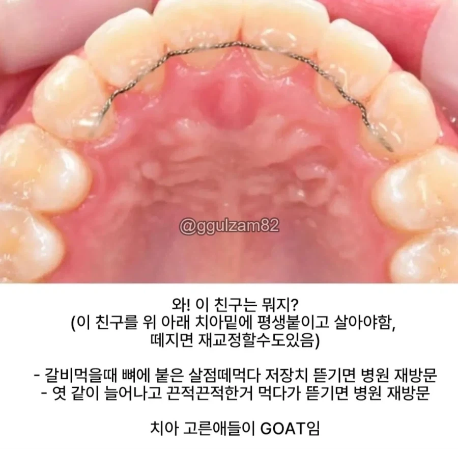 교정 안한 사람들은 모른다는 치아 교정인의 인생.jpg_3.webp