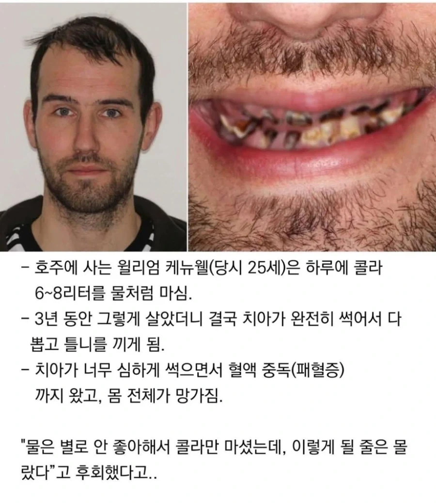 3년간 콜라먹은 남자 최후_1.webp