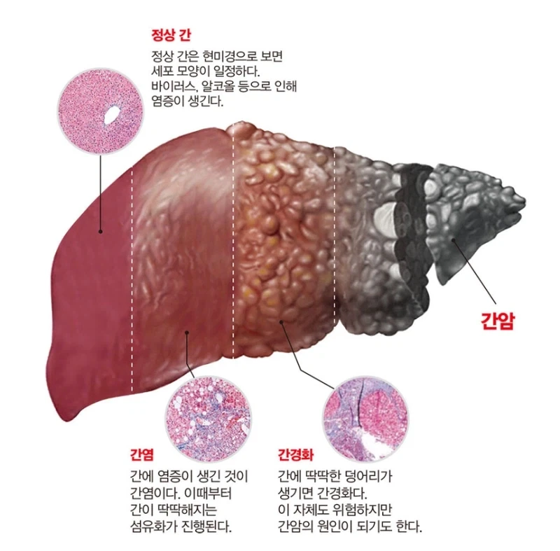점점 죽어가는 간.jpg_1.webp
