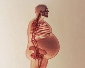 고도비만환자가 허리디스크를 달고 사는 이유.jpg_1.webp