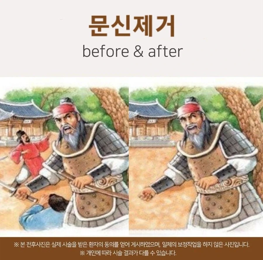 문신 제거 후기.jpg_1.webp