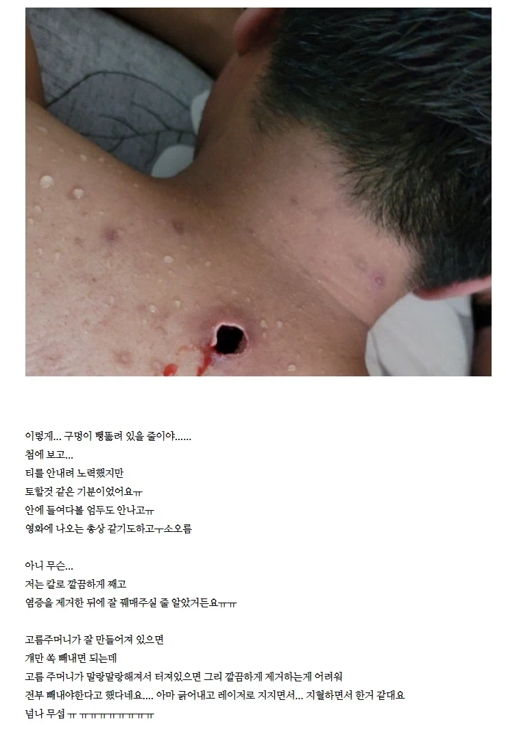 (혐) 옛 시절 사람 많이 죽였다는 등창_1.webp