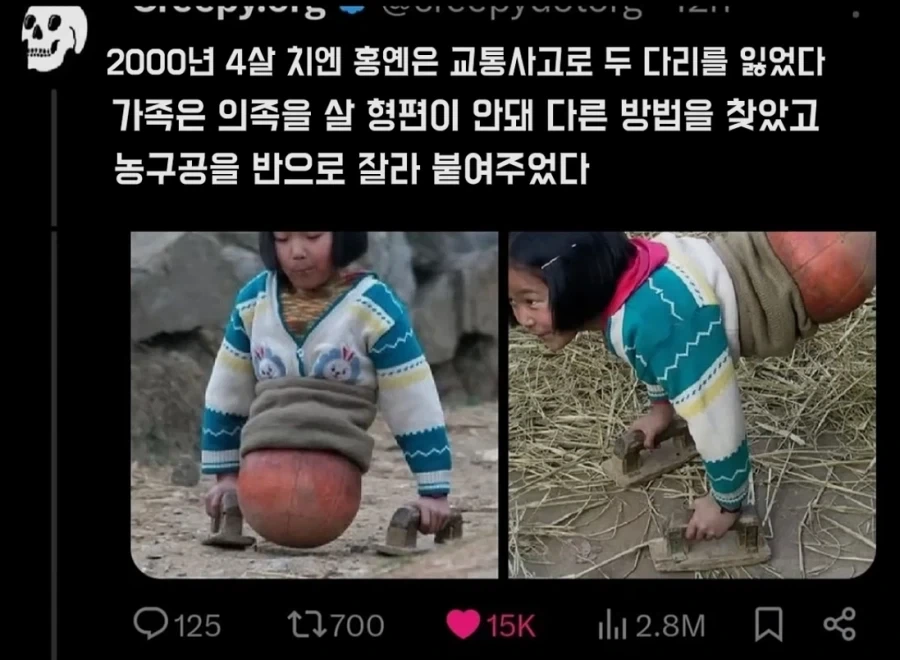 의족을 살 형편이 안됐던 가족들_1.webp