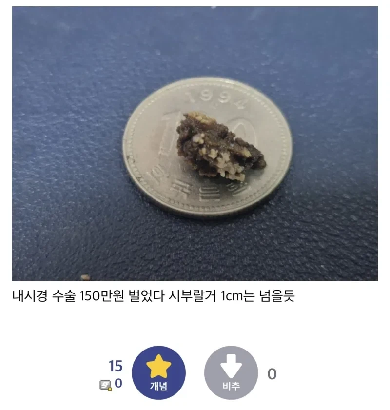 자연배출로 요로결석 배출한 디시인_2.webp