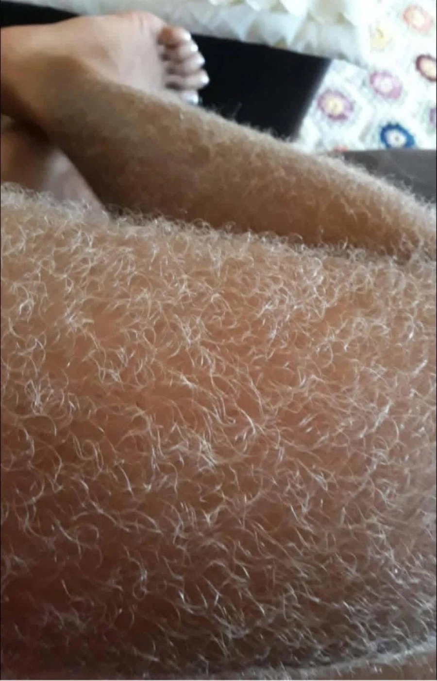 레이저 제모를 한 어느 여성에게 일어난 부작용;;_3.webp