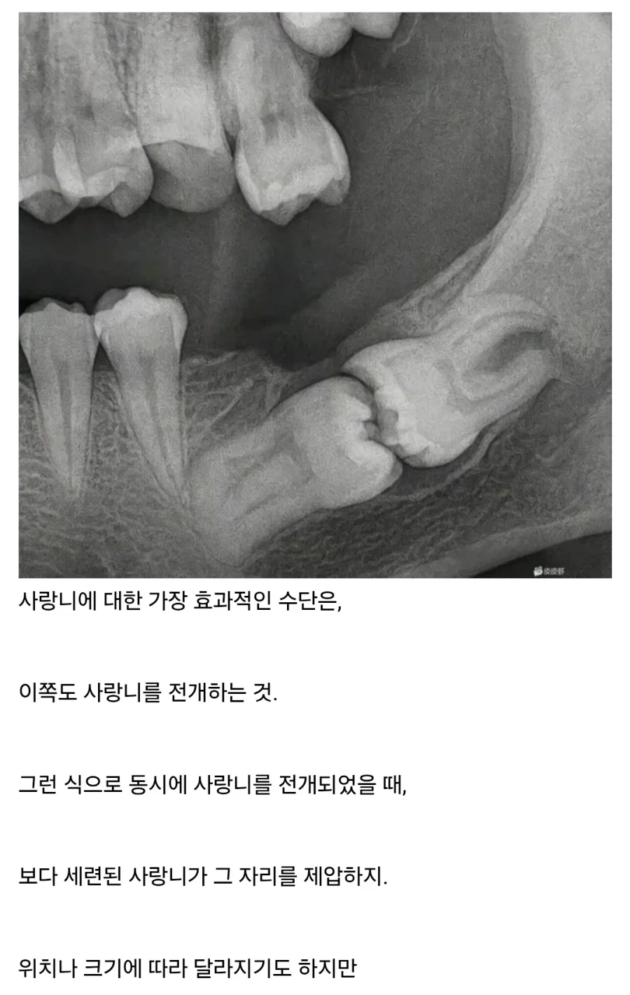 레전드 사랑니 영역전개 갑.jpg_1.webp