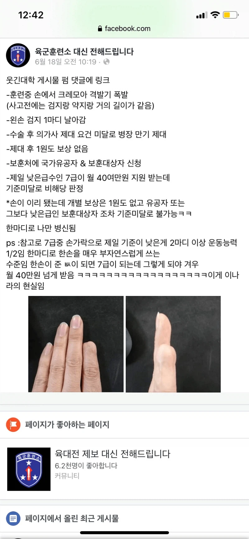 훈련중 크레모아 격발기에 손가락이 날아간 남자.jpg_1.webp