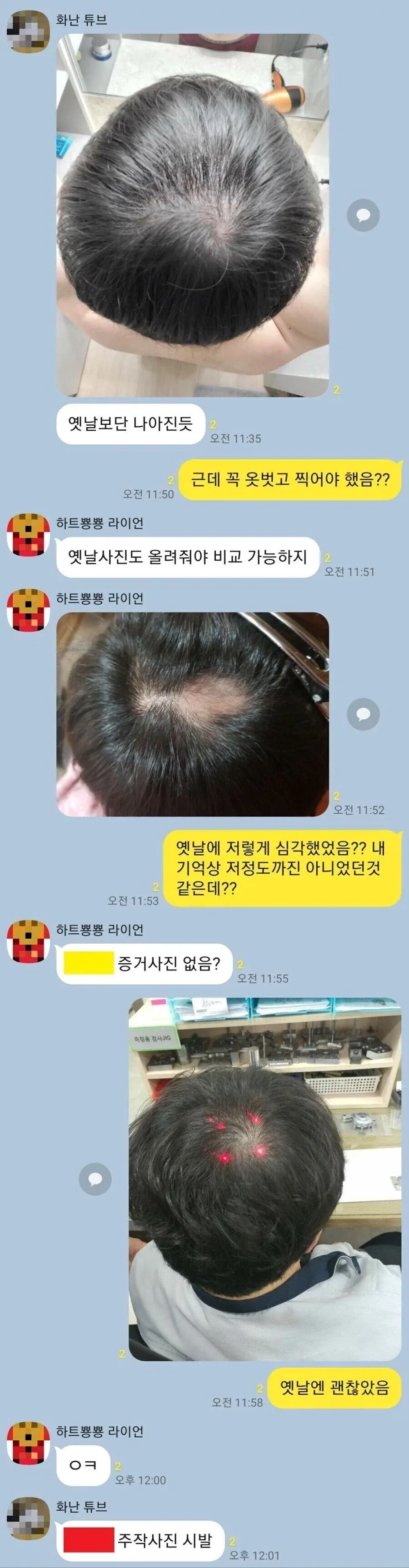 탈모가 고민인 친구_1.webp