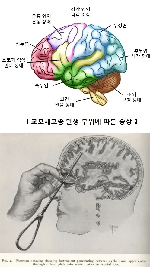 인류가 알고 있는 유일한 조현병 완치법._1.webp