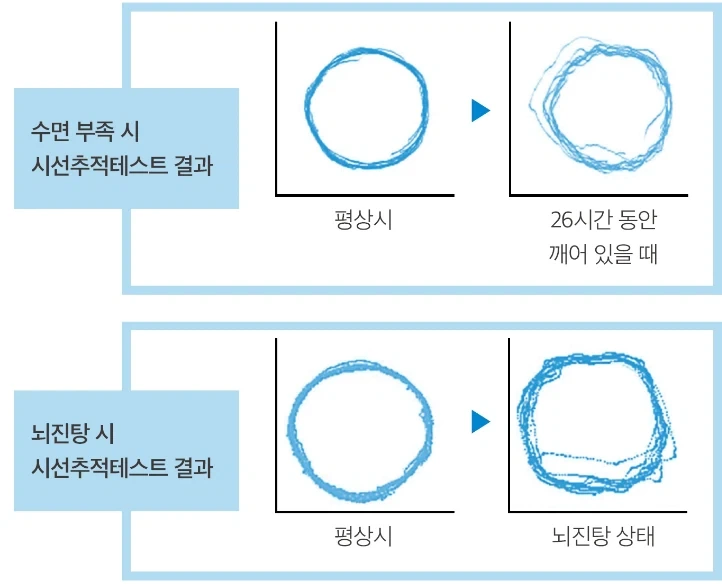 의외로 뇌진탕과 비슷한 상태라는 것.jpg_2.webp