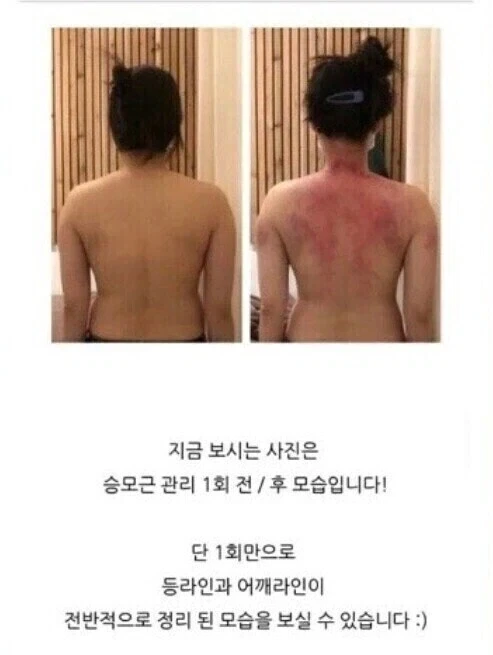 승모근 교정 후기_1.webp