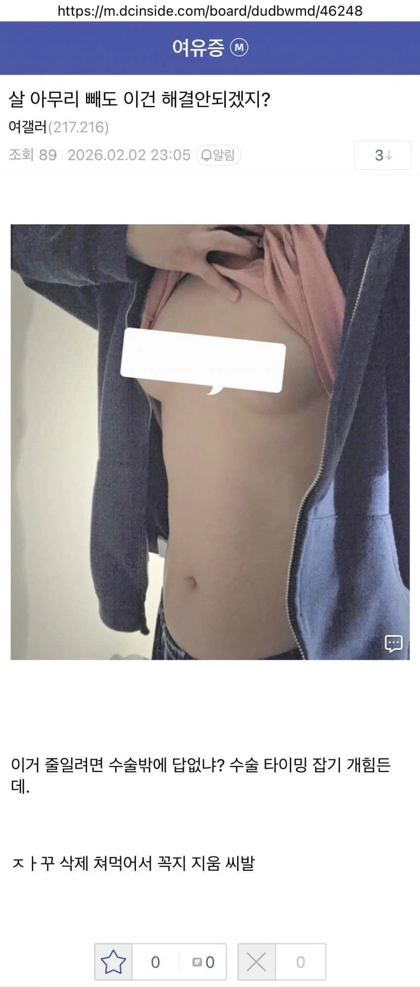 살빼도 안된다는 여유증 남자.jpg_1.webp