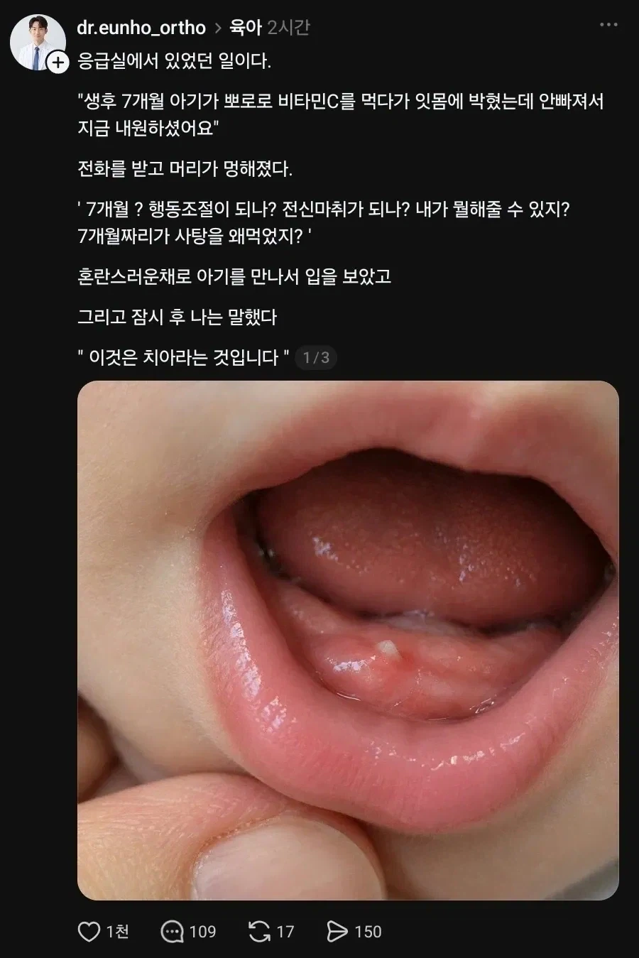 사탕 먹다가 잇몸에 박힌 아기.jpg_1.webp