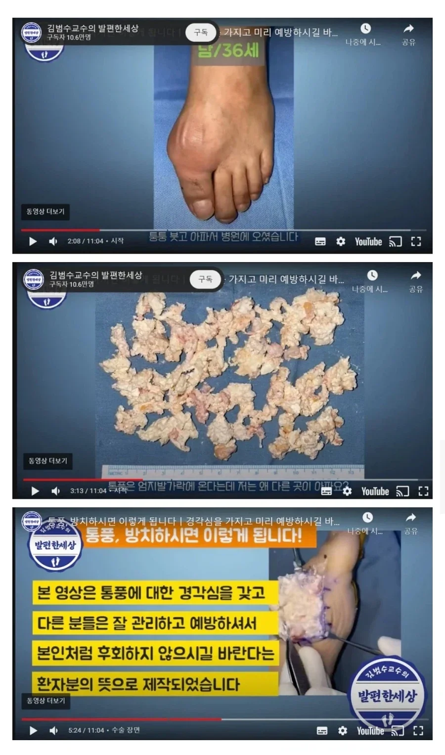 극혐) 몸에서 탕수육을 생산하는 통풍환자 수술_1.webp