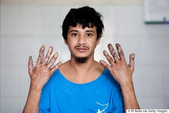 혐) 사마귀 질환이 잘못되면 발생하는.._1.webp