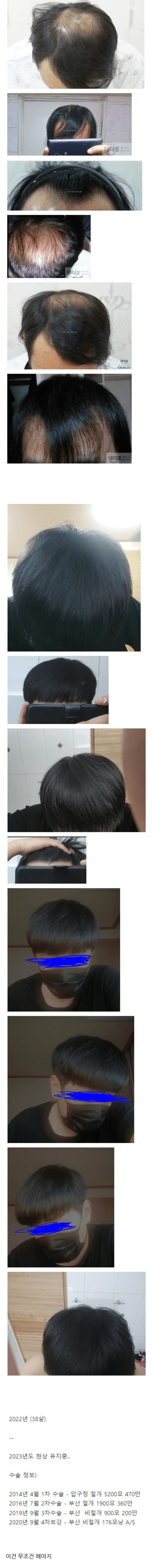 모발이식에 천만원 투자한 38살_1.webp