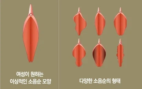 소음순 정리_1.webp