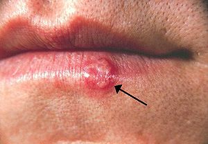 300px-Herpes(PHIL_1573_lores).jpg