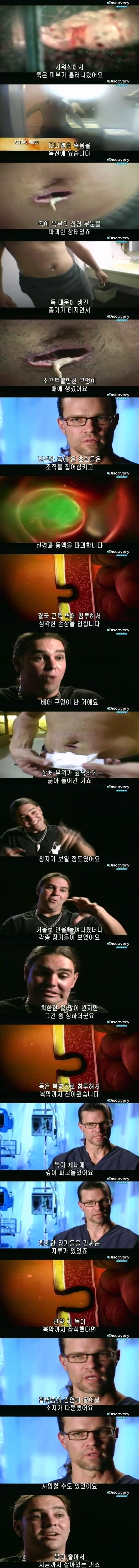 [극혐] 코브라한테 물려서 몸에 구멍이 생긴 남자.jpg_10.jpg