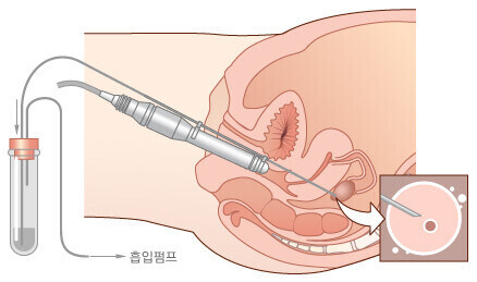 정액 착정보다 무서운