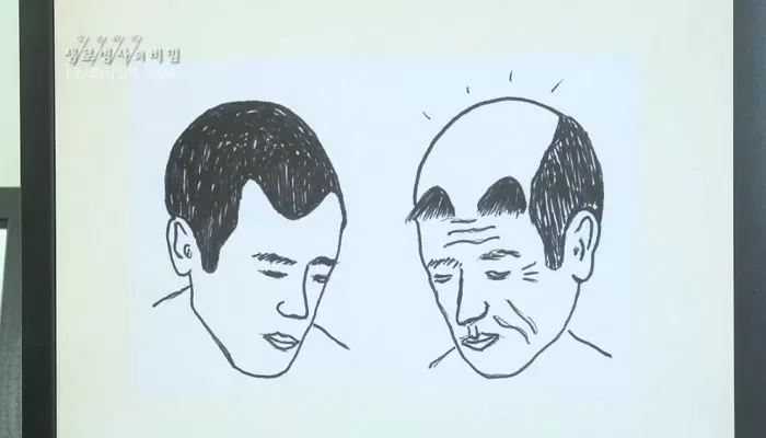 모발이식의 충격적인 결말_1.webp