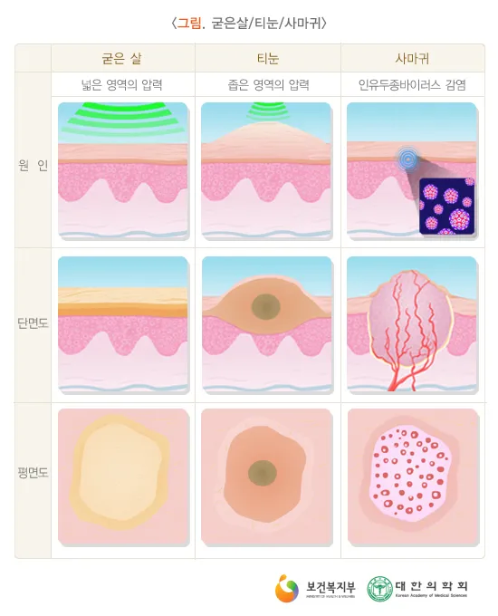 사마귀가 커지면 수술 어렵긴 하겠네..._1.webp