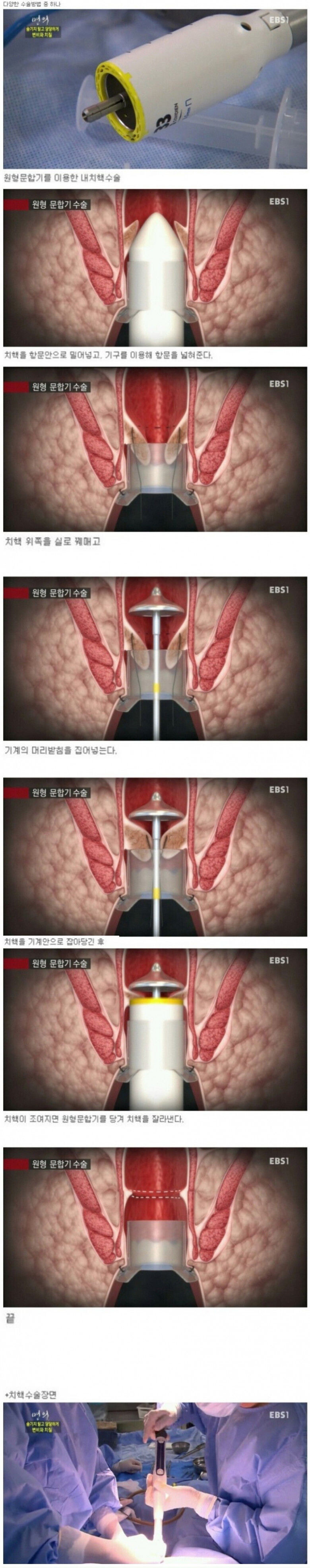 치질 걸리면 만나는 기계.jpg_1.jpg