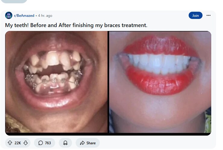 약혐? 레딧 유저의 교정전과 교정후 비교 사진.JPG_2.png