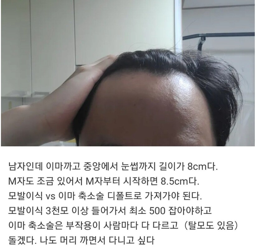 탈모 때문에 고민인 사람.jpg_1.png