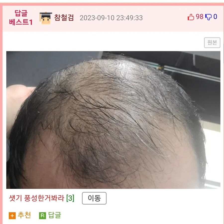 탈모 때문에 고민인 사람.jpg_3.png
